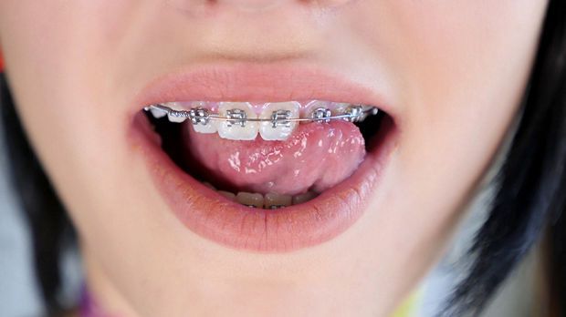 Brace Faced